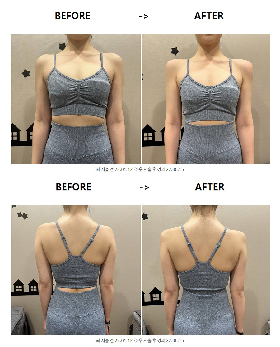 여자 어깨뽕 버리고 GAG지게! 어깨필러하세요! : 네이버 블로그