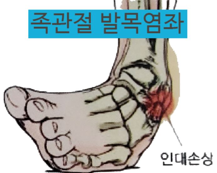 [최소자극 도침] 발목이 삐었을시 골절감별 및 치료는 : 네이버 블로그