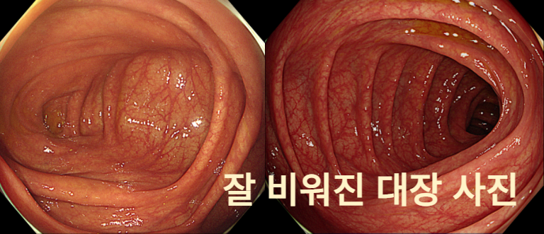 부산 대장내시경 전 식단 총정리: 수영구 내과 전문의가 알려주는 먹어도 되는 음식 %EC%A0%9C%EB%AA%A9%EC%9D%84 %EC%9E%85%EB%A0%A5%ED%95%98%EC%84%B8%EC%9A%94 (10)