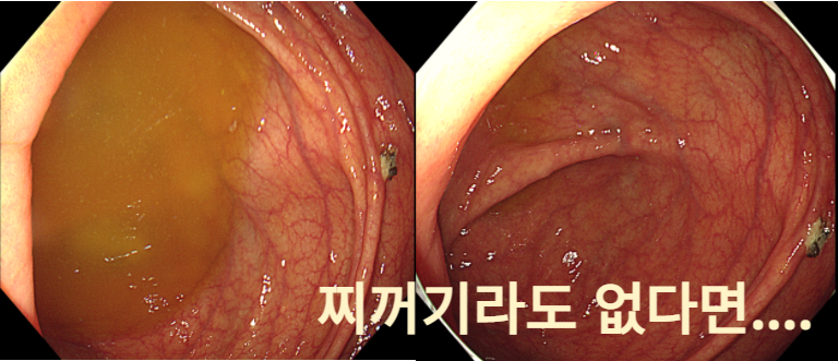 부산 대장내시경 전 식단 총정리: 수영구 내과 전문의가 알려주는 먹어도 되는 음식 %EB%B3%B5%EC%82%AC%EB%B3%B8 %EC%A0%9C%EB%AA%A9%EC%9D%84 %EC%9E%85%EB%A0%A5%ED%95%98%EC%84%B8%EC%9A%94 (1)