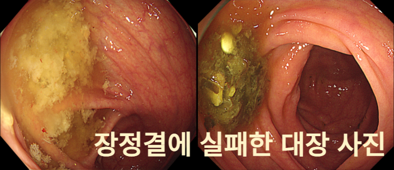 부산 대장내시경 전 식단 총정리: 수영구 내과 전문의가 알려주는 먹어도 되는 음식 %EC%A0%9C%EB%AA%A9%EC%9D%84 %EC%9E%85%EB%A0%A5%ED%95%98%EC%84%B8%EC%9A%94 (11)