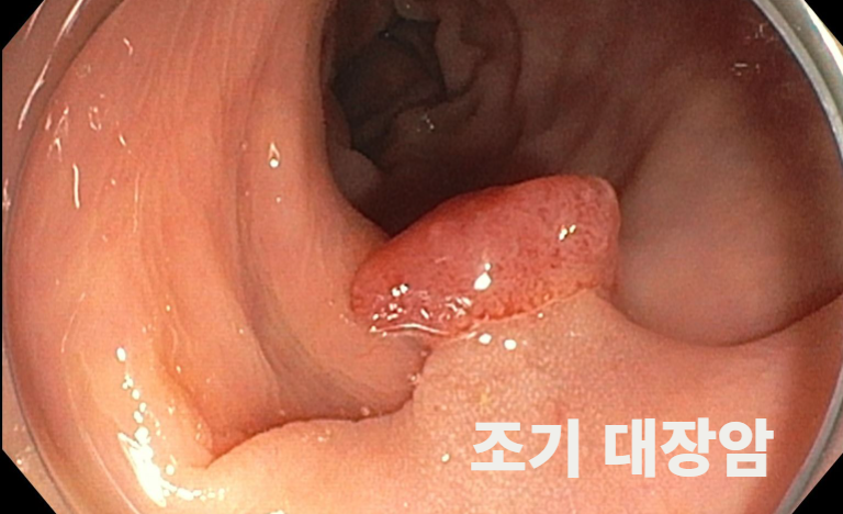 당일 용종절제술로 제거한 조기 대장암