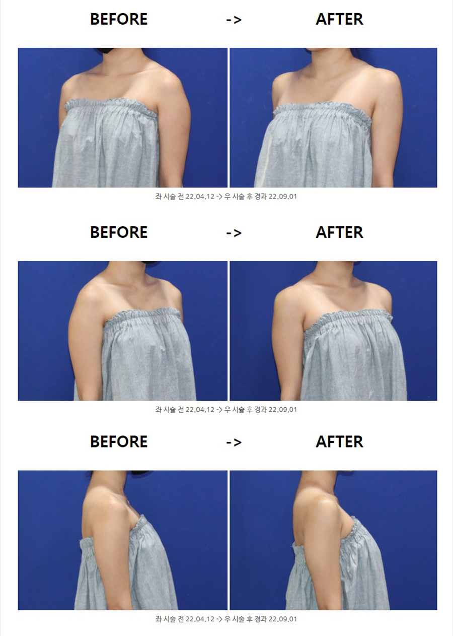 여자어좁이 GAG지게 필러 하나면 OK! : 네이버 블로그