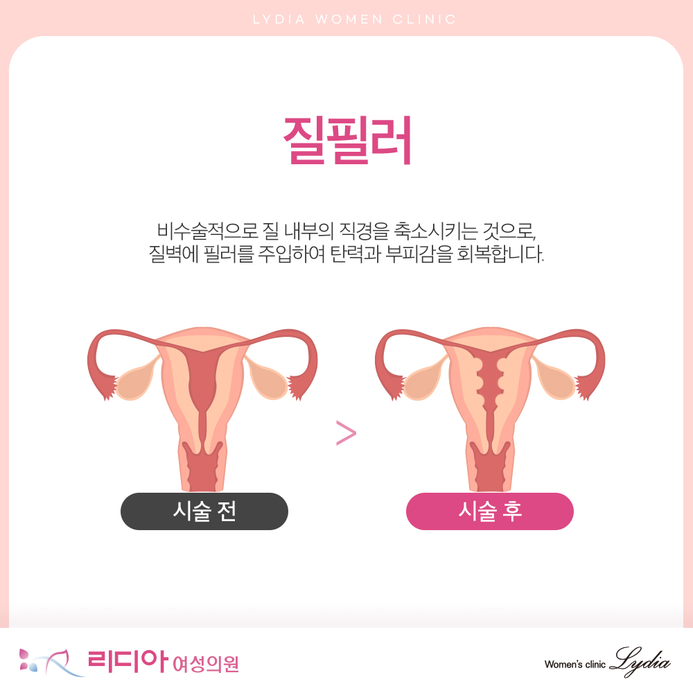 강남질필러 필요한 이유 노화와 출산 뒤 질 탄력 저하로 생긴 일상 불편감