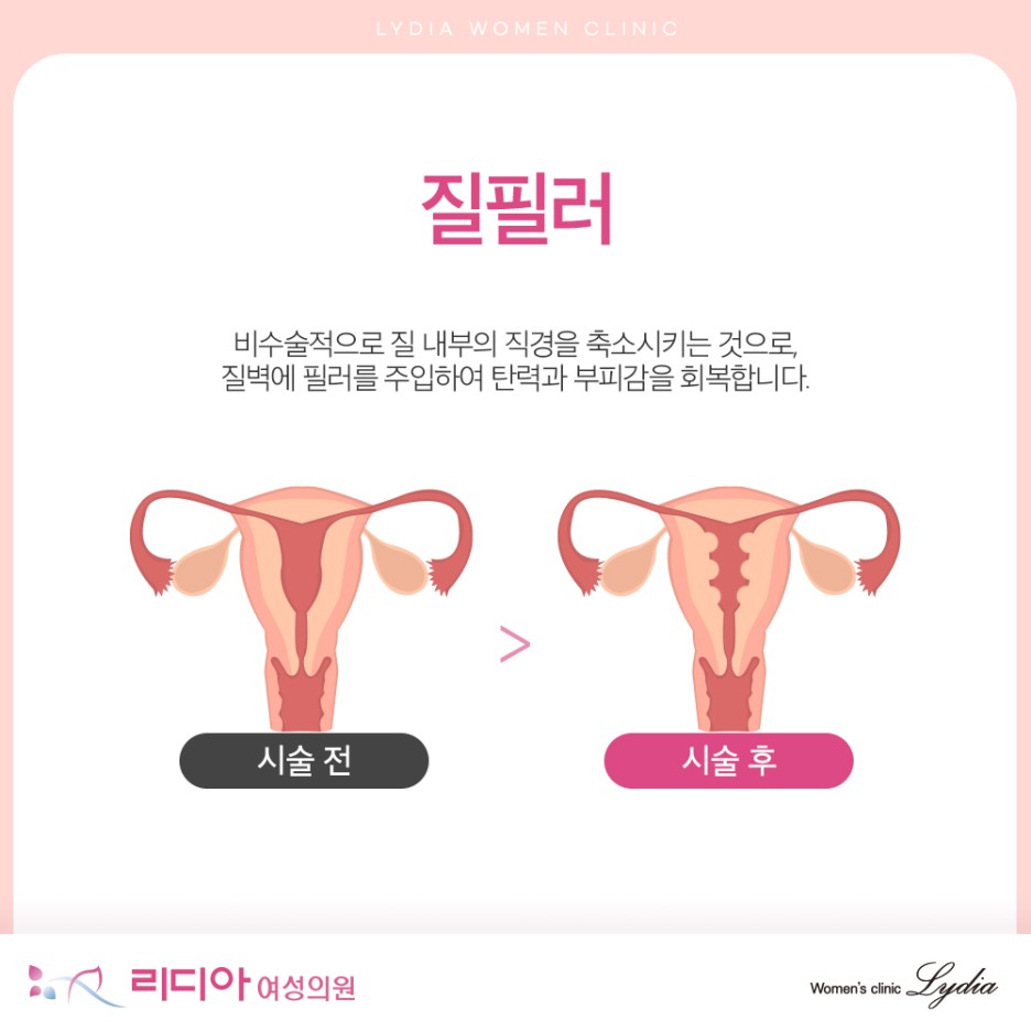 강남질필러 비수술 질 탄력 개선과 반영구 효과 고려점 여성 신체 변화 대안