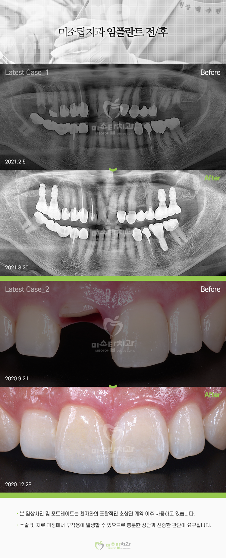 천호동임플란트 안정적인 과정으로 : 네이버 블로그, image size:750x1850