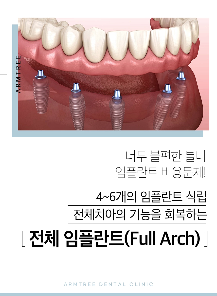 임플란트 잇몸뼈 만들기! 단순한 뼈이식과 골형성의 차이 임플란트 식립이 가능하기 위해서는 임플란트를 유착시킬만한 잇몸뼈의 양과 두께가  필요합니다. 만약 잇몸뼈가 부족한 경우, 뼈이식을 통해 잇몸뼈를 재건한 후 식립을 진행하게 되는데요. 뼈이식으로도 잇몸뼈가 ..., image size:880x1200