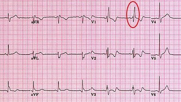 우각차단 RBBB right bundle branch block 원인 증상 심전도 EKG 특징 예후 치료 (+심장 자극전도계 ...