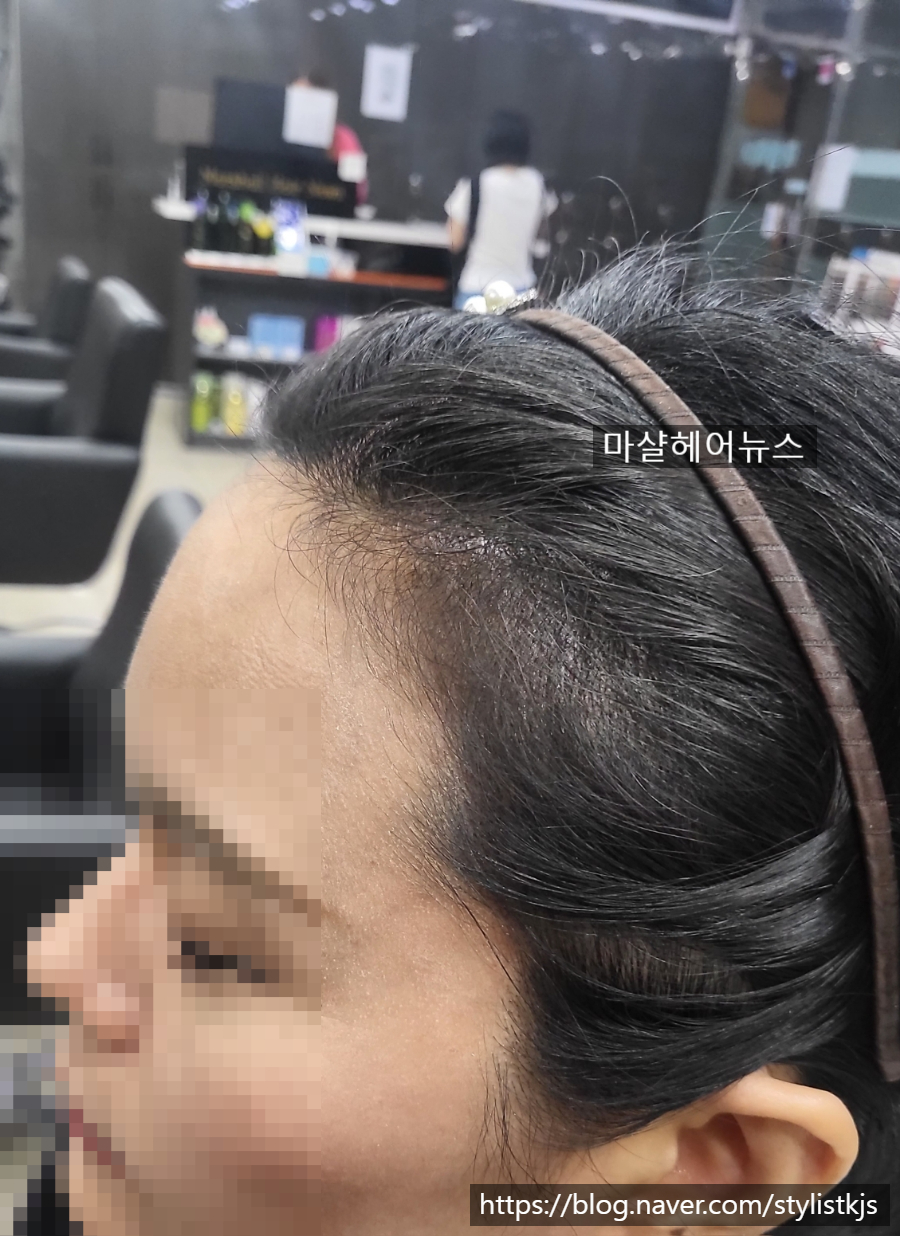 마샬헤어라인 이미지