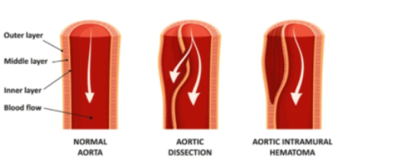 상장간막동맥 박리 (SMA Dissection)란? : 네이버 블로그