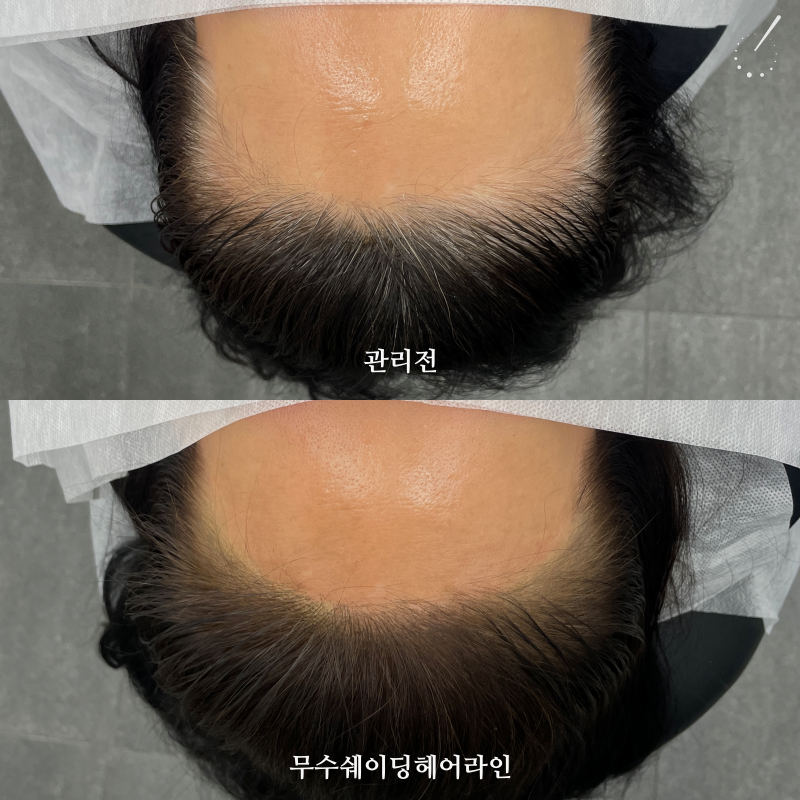 진헤어라인 이미지