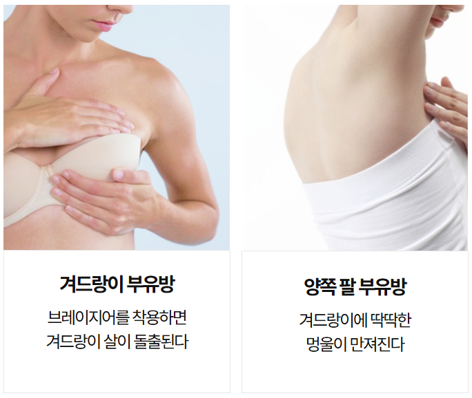 image8 SC301 부유방 제거성형, 어떤 경우에 필요할까요?