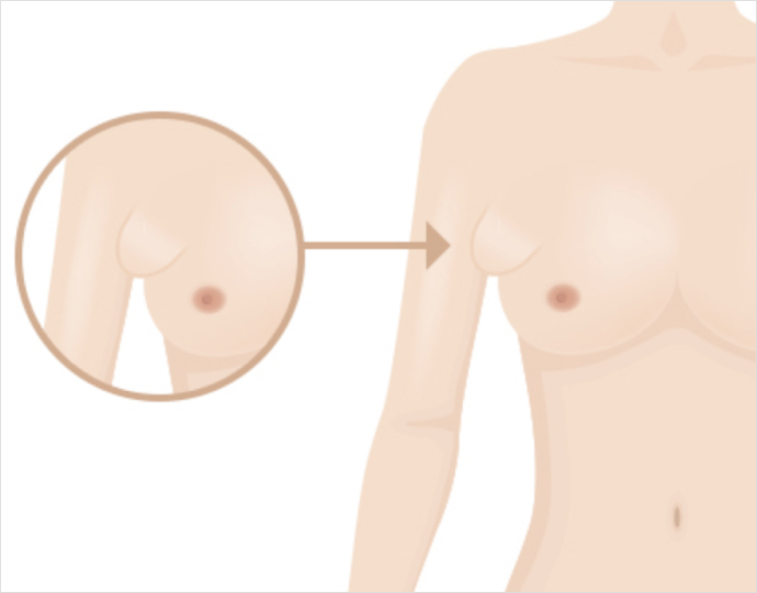 image10 SC301 부유방 제거성형, 어떤 경우에 필요할까요?