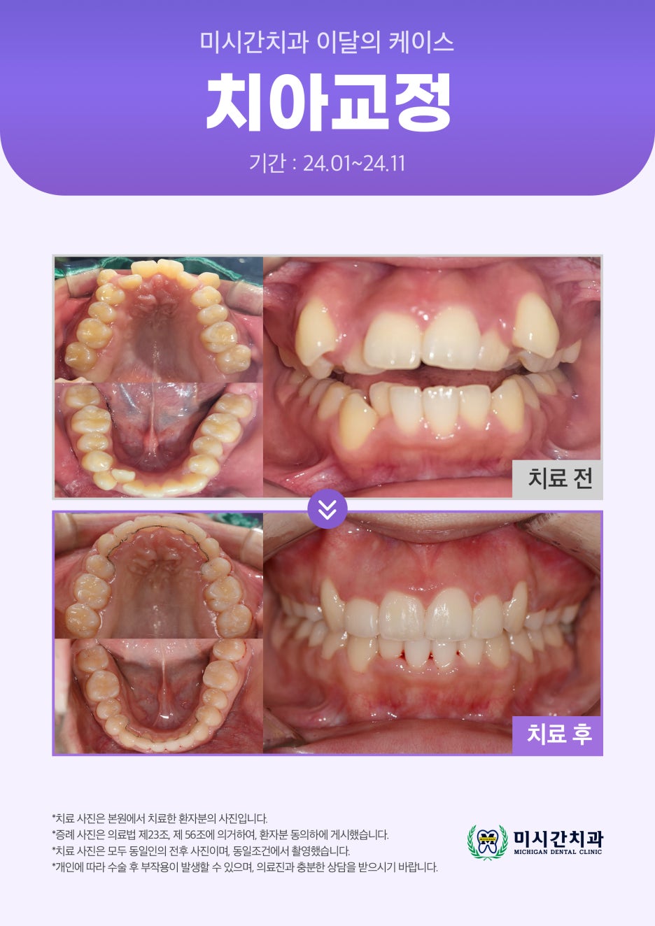 ●25.03.19_미시간치과_이달의_케이스1.jpg