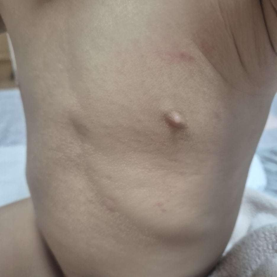 정상체온으로 돌아 온후 하나 둘 나타나기 시작하는 붉은 반점