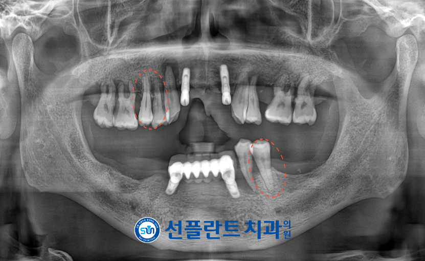 용인선플란트치과-임플란트-치조골소실확인