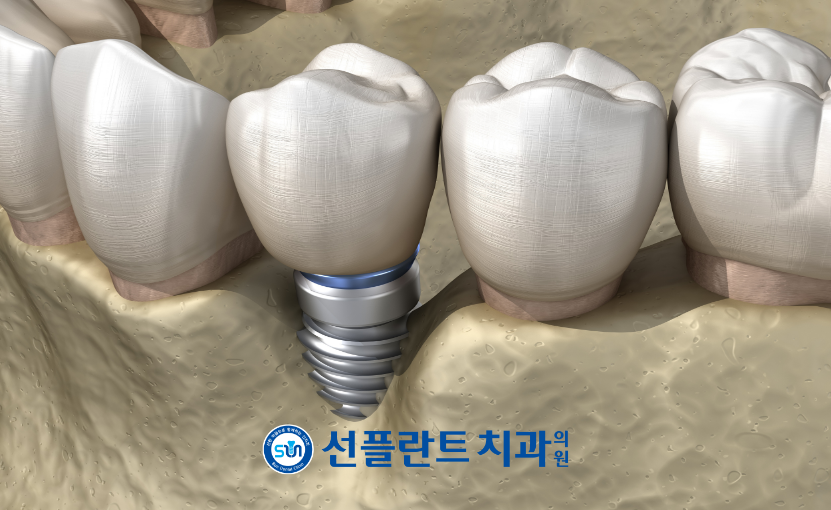 용인선플란트치과-임플란트-임플란트 주위염 이미지