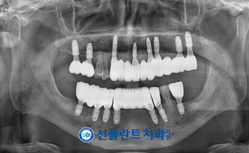 용인선플란트치과-임플란트-치료 마무리된 파노라마 사진