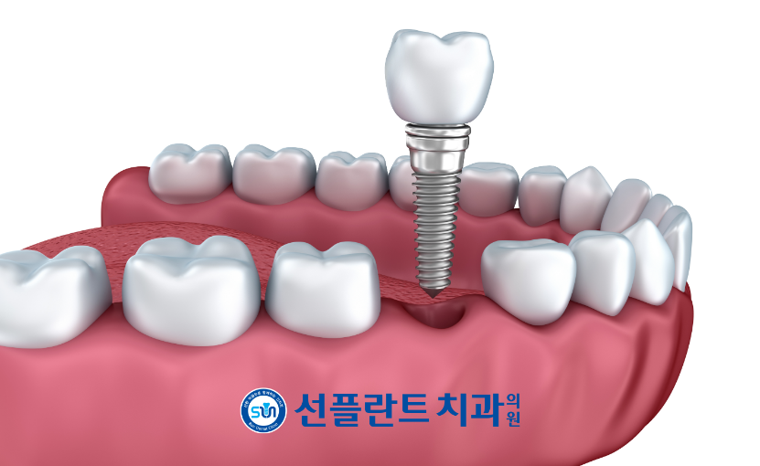 용인선플란트치과-임플란트-식립이미지