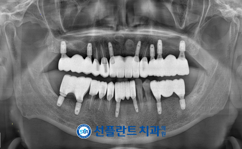 김량장동치과-용인선플란트치과-치료 후 파노라마사진