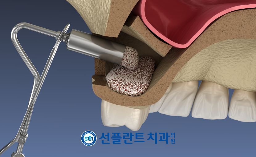 김량장동치과-용인선플란트치과-측방접근법 이미지2
