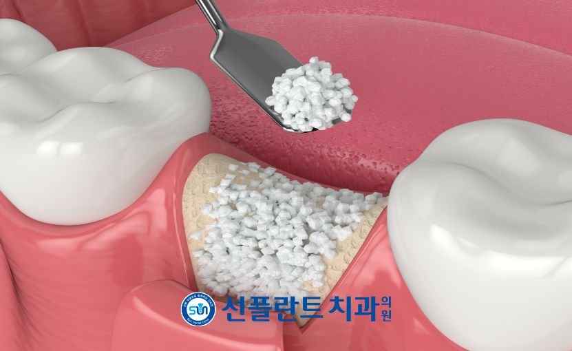 김량장동치과-용인선플란트치과-뼈이식 이미지
