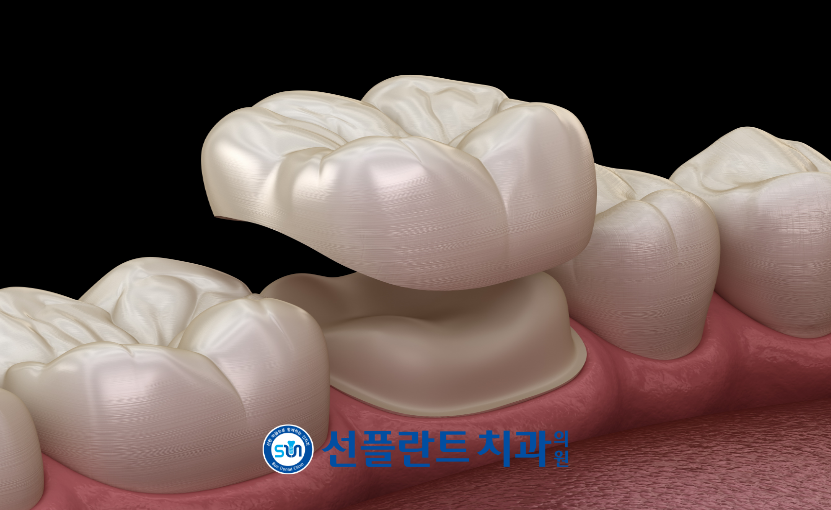 김량장동치과-용인선플란트치과-신경치료후 크라운수복 이미지