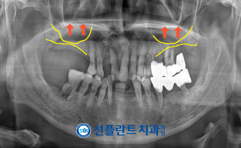 김량장동치과-용인선플란트치과-위턱양측 어금니가 상악동 막이 아래로 내려와있는 파노라마