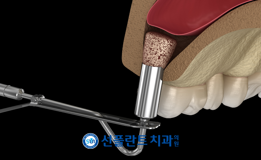 김량장동치과-용인선플란트치과-치조정접근법 이미지