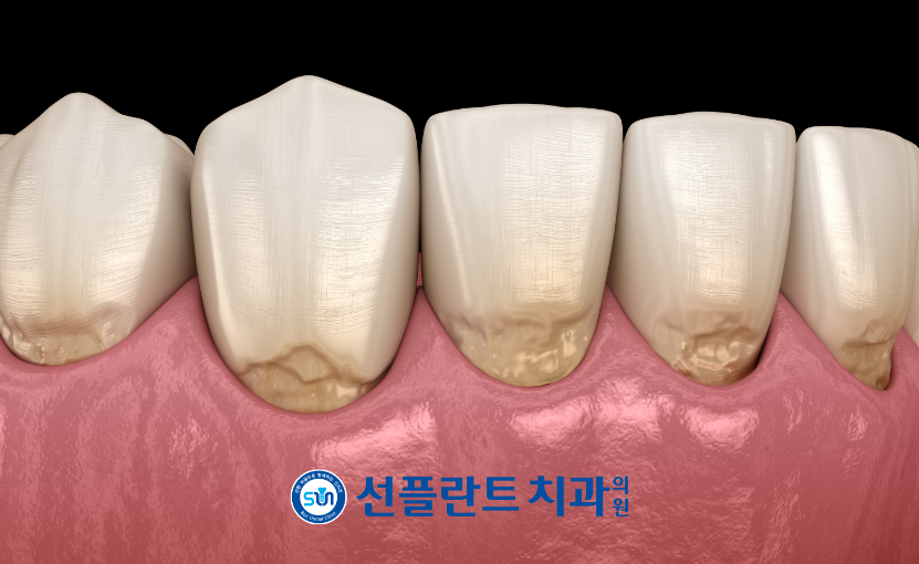 김량장동치과-용인선플란트치과-닳아진 치경부위 이미지