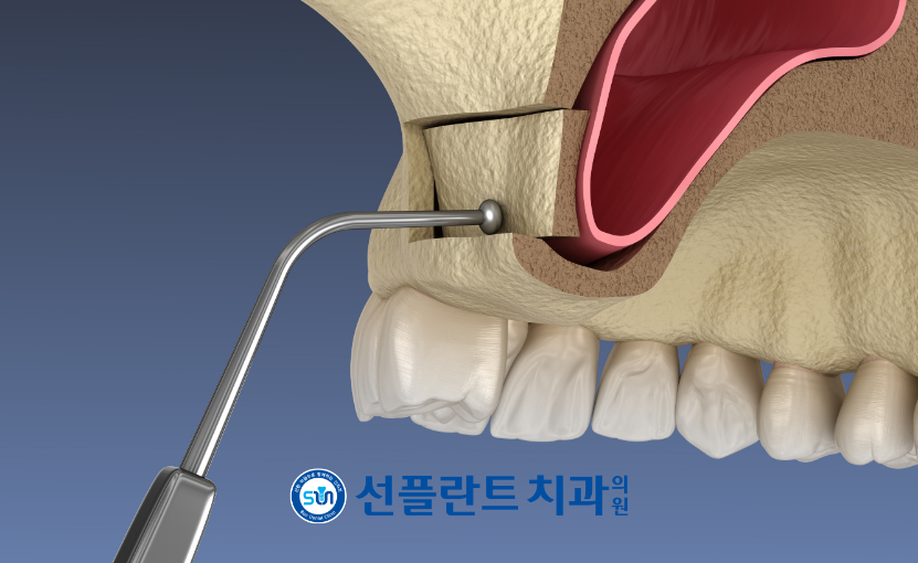 김량장동치과-용인선플란트치과-측방접근법 이미지1