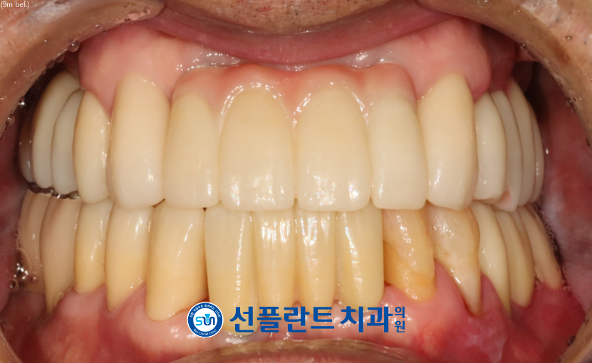 김량장동치과-용인선플란트치과-치료 후 구강 내 사진