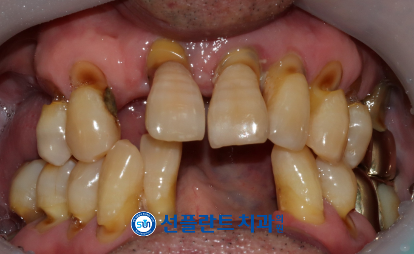 김량장동치과-용인선플란트치과-앞니와 오른쪽 위아래 어금니 상실된 치료전 사진