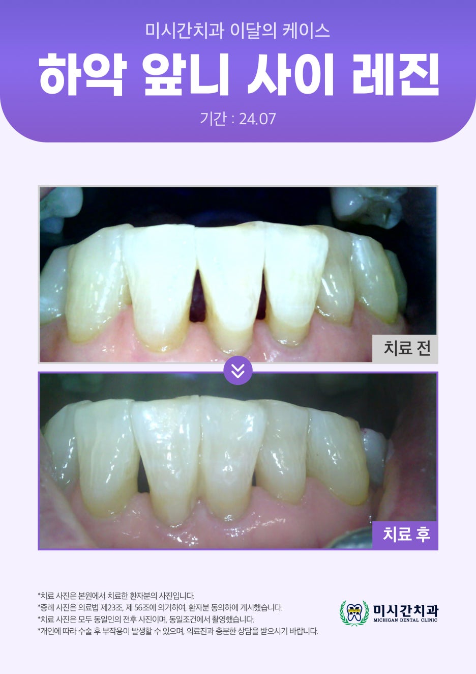 ●25.03.19_미시간치과_이달의_케이스11.jpg