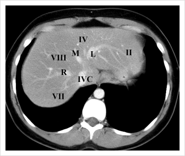 CT와 sono상의 Liver segmental 비교 : 네이버 블로그